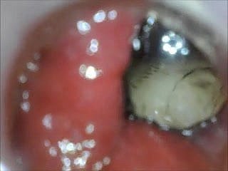 Anal Endoscope Irritant Shtick od wewnątrz